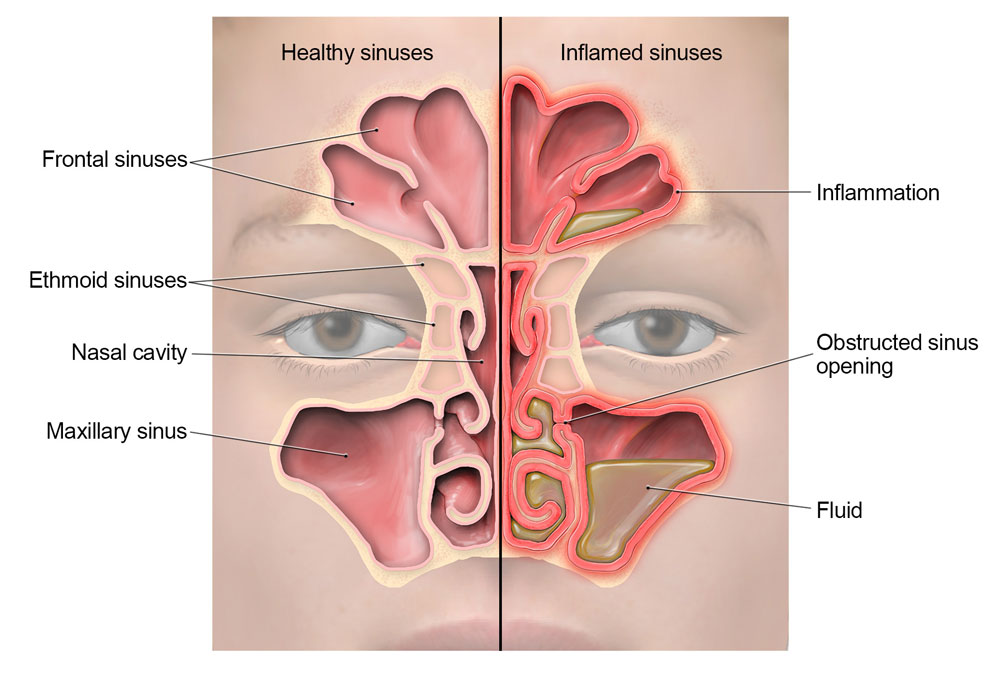 sinusitis-lg.jpg