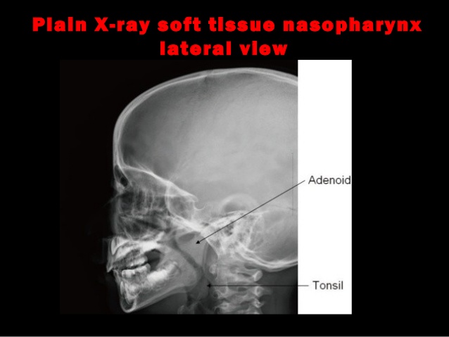 3tonsils-and-adenoids-40-638.jpg