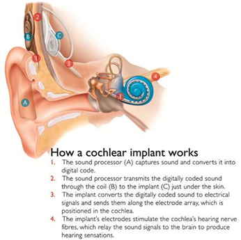 Cochlear-implant-schematic.jpg